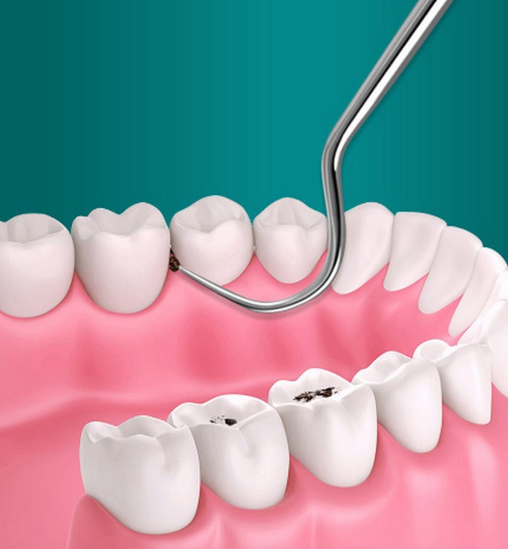 Bộ Dụng Cụ Bằng Inox Giúp Làm Sạch Răng Miệng