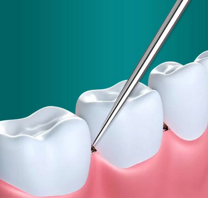 Bộ Dụng Cụ Bằng Inox Giúp Làm Sạch Răng Miệng